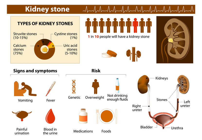 what causes staghorn kidney stones